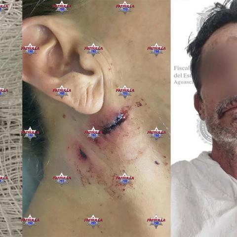 La víctima estuvo hospitalizada una semana hasta que pudieron extraer la bala