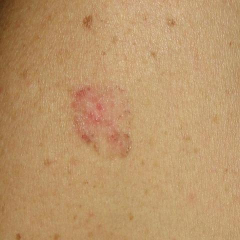 Carcinoma basocelular 