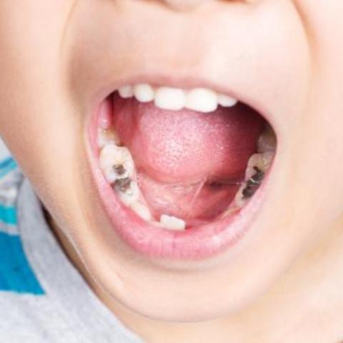 Caries en infantes