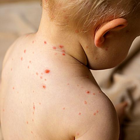 Bebé de 8 meses se contagia de sarampión; es el cuarto caso confirmado