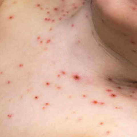 Alerta ISSEA por caso sospechoso de sarampión en Aguascalientes