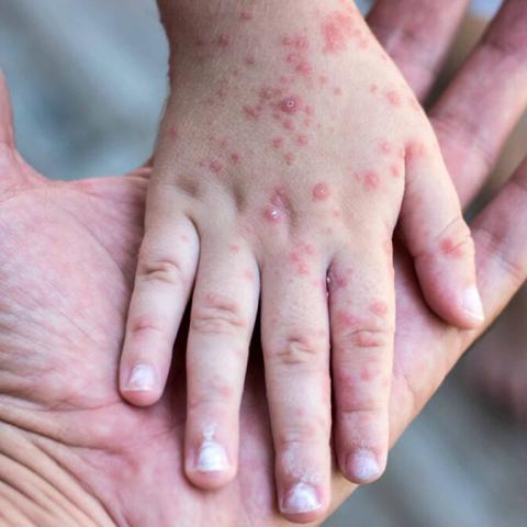 Casos de sarampión en México alcanzan 8 mil 459 en 300 municipios