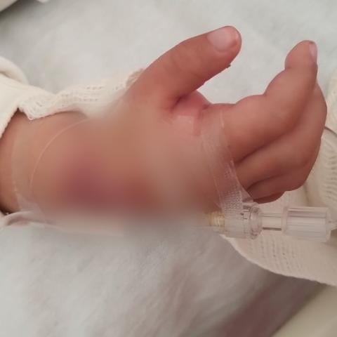 Denuncian presunta negligencia médica en el IMSS; bebé sufre quemadura por catéter