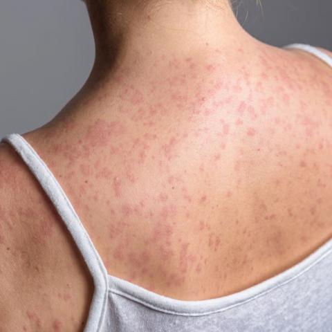 Aguascalientes refuerza campaña de vacunación ante alerta por sarampión