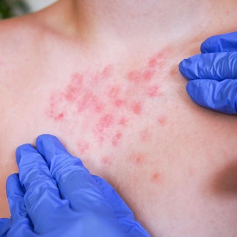 Confirman 3 contagios más de sarampión en Aguascalientes; advierten circulación local del virus