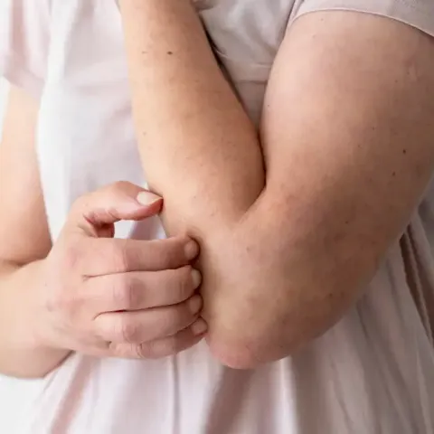 Aguascalientes alcanza contagio 25 de sarampión; médico de farmacia, uno de los afectados 