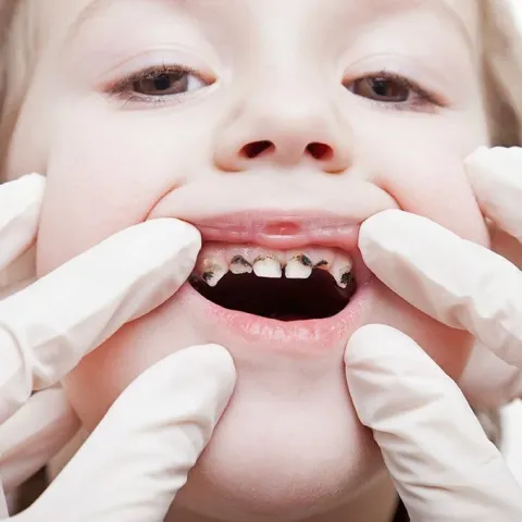caries en infantes