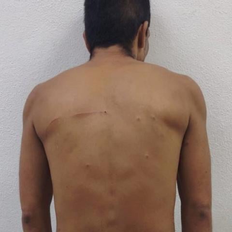 lesiones 