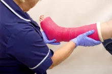 Sin necesitarlo, IMSS Aguascalientes le enyesa ambas piernas a una paciente; CNDH emite recomendación
