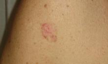 Carcinoma basocelular 