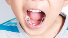 Caries en infantes