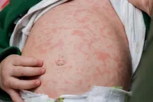 Suman 147 casos probables de sarampión en Aguascalientes; ISSEA contempla refuerzo de vacunación