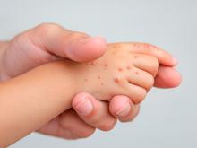 Séptimo contagio de sarampión llega a Aguascalientes; es una niña de dos años