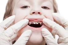 caries en infantes